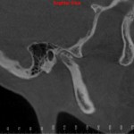Grayscale 3D CT scan: lateral skull view with red marker on cranium