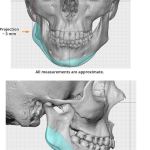 Frontal and lateral 3D skull models showing projection measurements: +3 mm (frontal), +2.6 mm and +3 mm (lateral). All measurements approximate