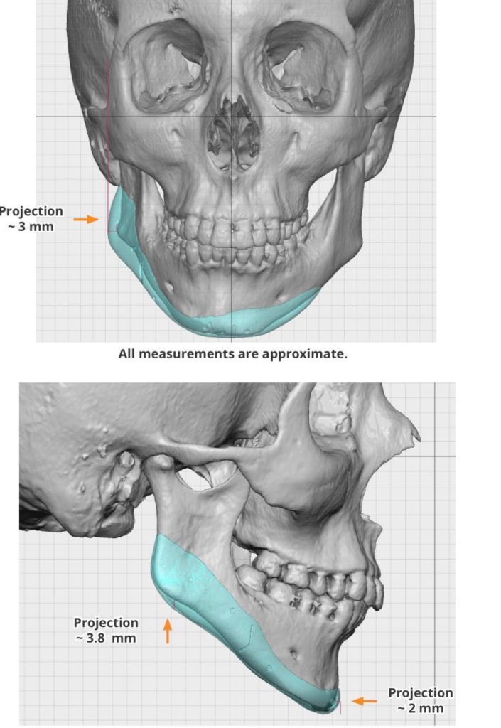 Frontal and lateral 3D skull models showing projection measurements: +3 mm (frontal), +2.6 mm and +3 mm (lateral). All measurements approximate