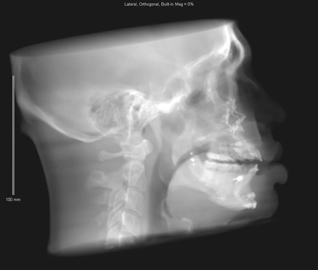 Lateral skull X-ray showing dental work, cervical spine, and intact maxillary sinus