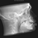 Lateral skull X-ray showing dental work, cervical spine, and intact maxillary sinus