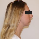 Profile view: female patient with blonde hair, neutral expression, black top, eyes obscured