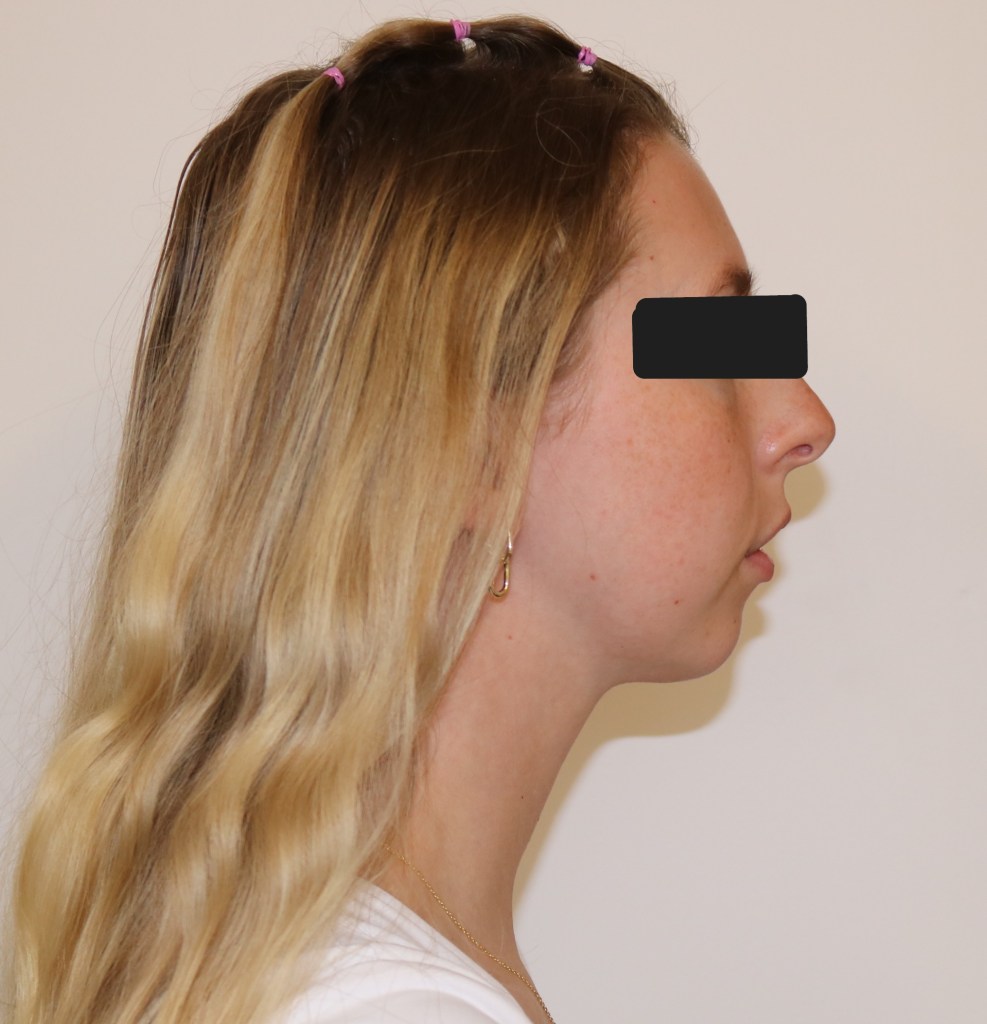 Profile view: female patient with blonde hair, neutral expression, black top, eyes obscured