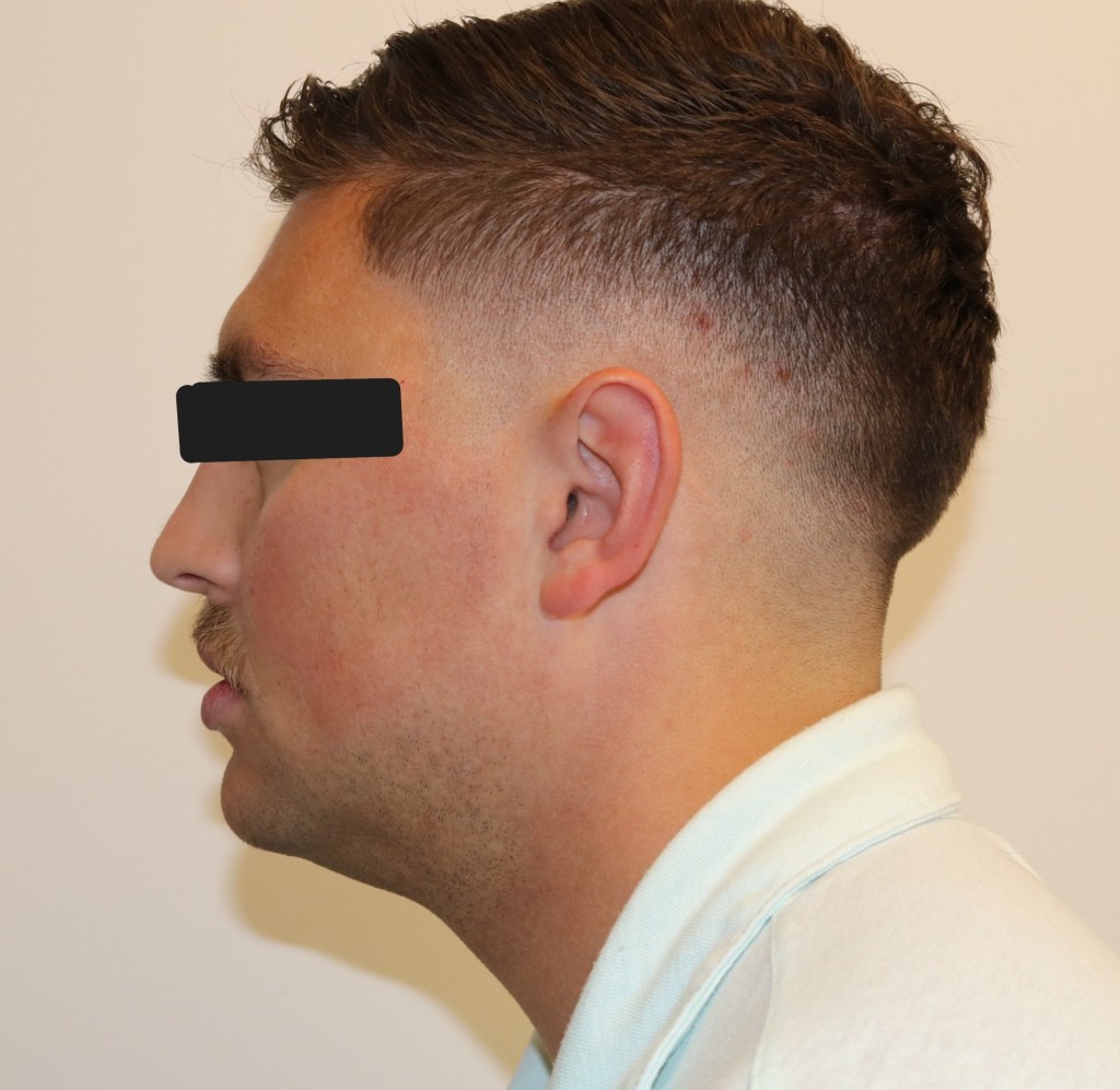 Profile view: male patient with short hair, eyes obscured