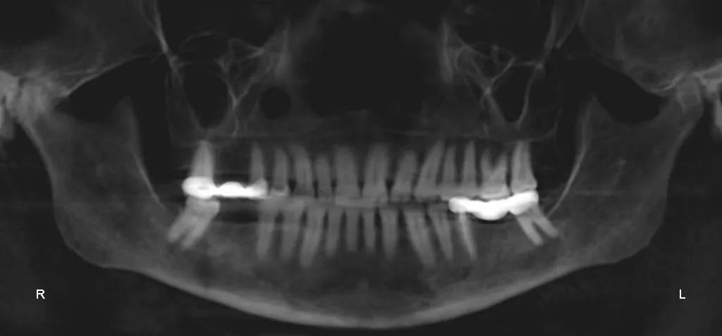 Panoramic dental X-ray showing full dentition, grayscale, dark background