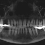 Panoramic dental X-ray showing full dentition, grayscale, dark background