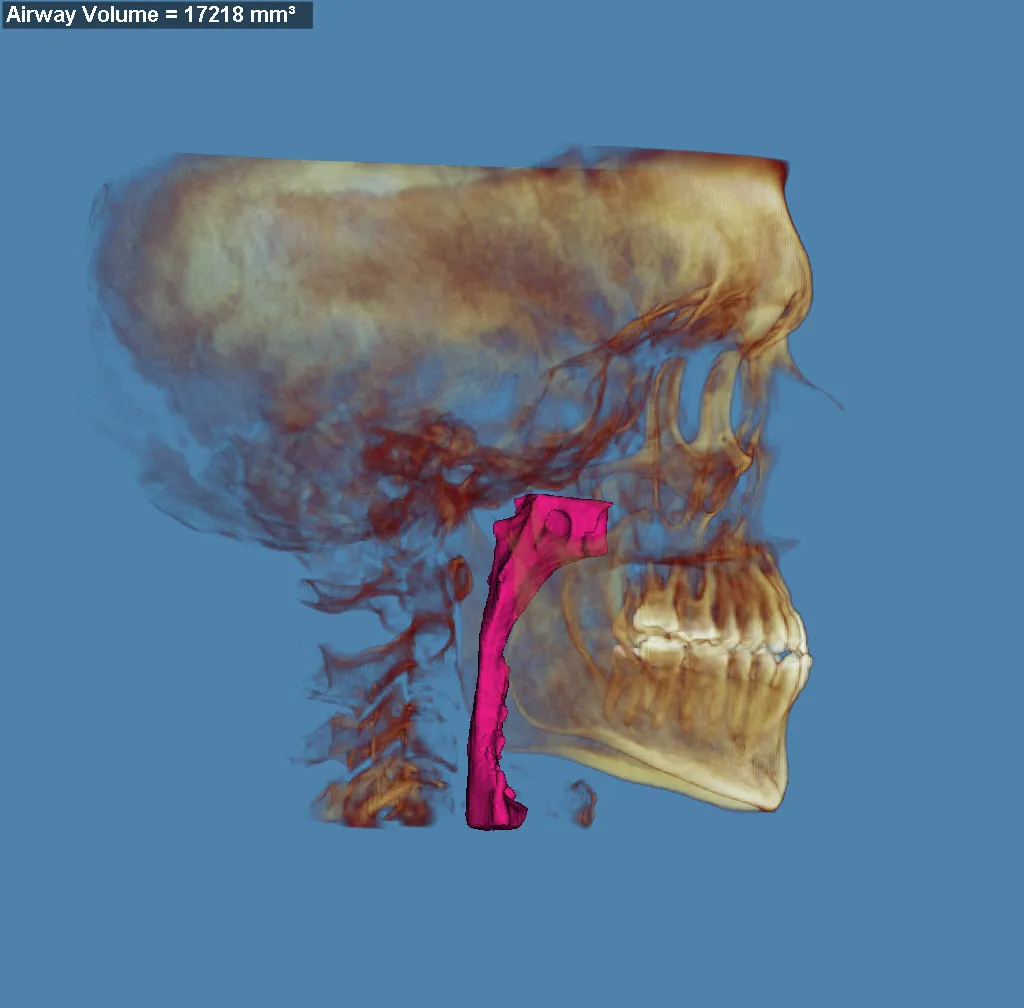 3D skull model with jaw highlighted in red and purple, blue background