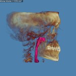 3D skull model with jaw highlighted in red and purple, blue background