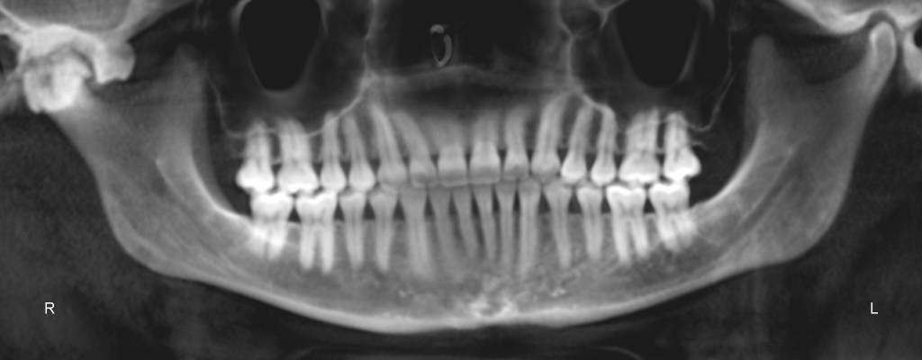 Panoramic dental X-ray: full dentition, grayscale, green marker on teeth