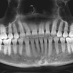Panoramic dental X-ray: full dentition, grayscale, green marker on teeth