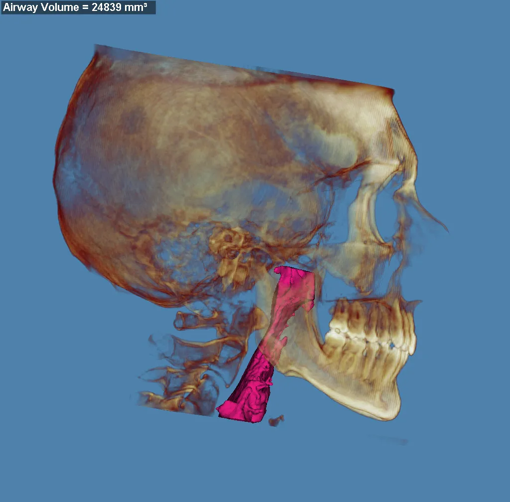 3D skull model with jaw highlighted in red and purple, blue background