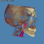 3D skull model with jaw highlighted in red and purple, blue background