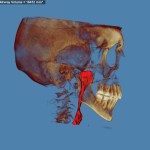 3D skull model with jaw highlighted in red/purple, blue background