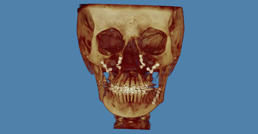 3D skull model: jaw highlighted in red, golden-brown tones, blue background