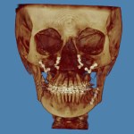 3D skull model: jaw highlighted in red, golden-brown tones, blue background