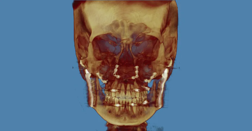 3D skull model in golden-brown tones, frontal view