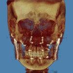 3D skull model in golden-brown tones, frontal view