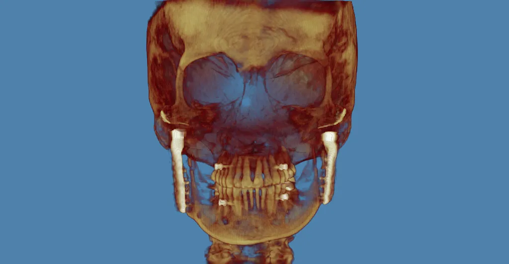 Grayscale 3D CT scan: lateral skull view with red marker on cranium