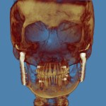 Grayscale 3D CT scan: lateral skull view with red marker on cranium