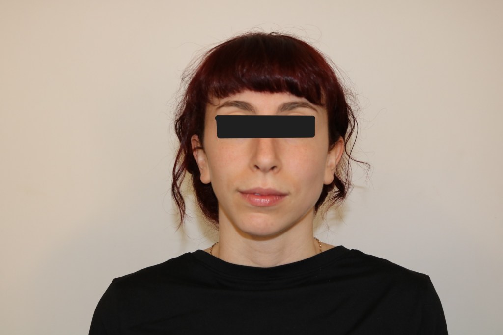 Neutral expression facial photo for orthodontic assessment, eyes obscured