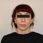 Neutral expression facial photo for orthodontic assessment, eyes obscured