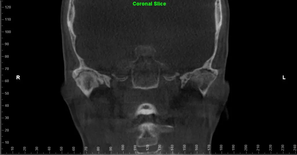Coronal CT scan: nasal cavity, sinuses, and orbits visible, grayscale