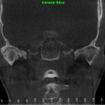 Coronal CT scan: nasal cavity, sinuses, and orbits visible, grayscale