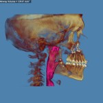 3D skull model with jaw highlighted in red and purple, blue background