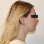 Profile view: female patient with blonde hair, neutral expression, black top, eyes obscured