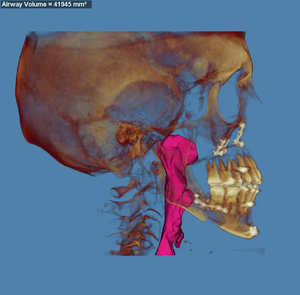 3D skull model with jaw highlighted in red/purple, blue background
