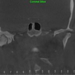 Coronal CT scan: nasal cavity and sinuses, grayscale, dark background