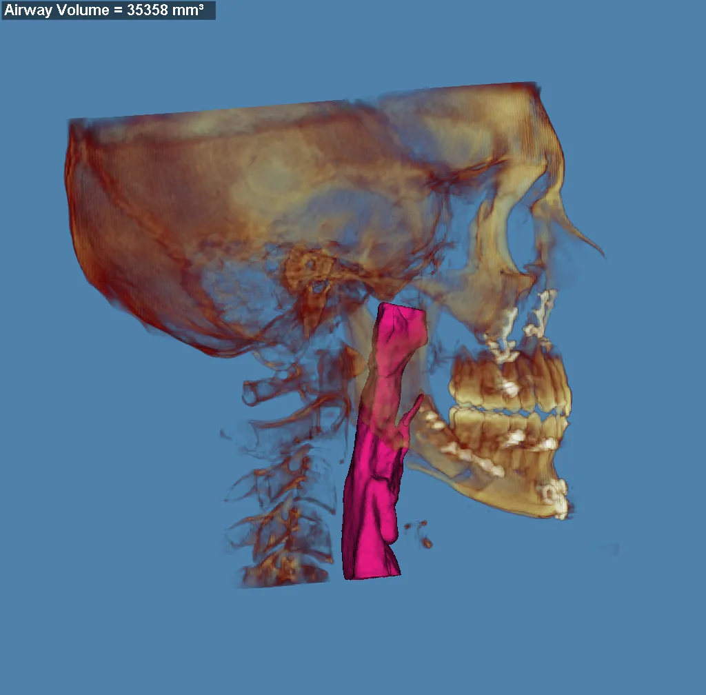 3D skull model with jaw highlighted in red and purple, blue background