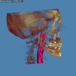 3D skull model with jaw highlighted in red and purple, blue background
