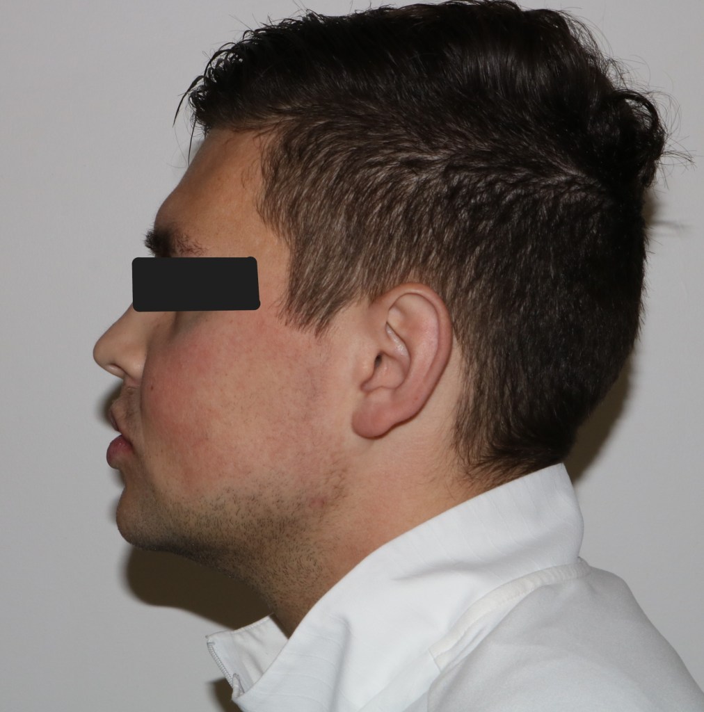 Profile view: male patient with neutral expression, eyes obscured