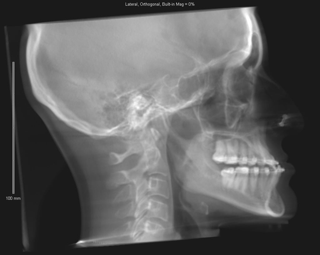 Lateral skull X-ray with dental implants, cervical spine, and visible maxillary sinus