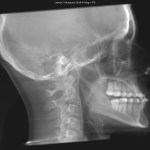 Lateral skull X-ray with dental implants, cervical spine, and visible maxillary sinus