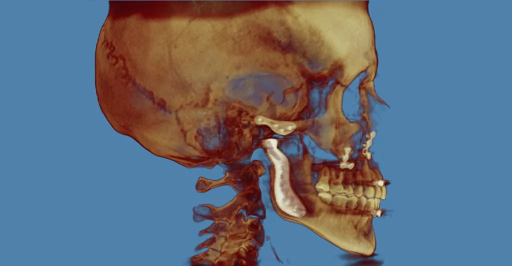 3D skull model in golden-brown tones, lateral view