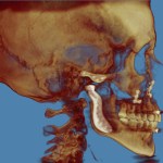 3D skull model in golden-brown tones, lateral view