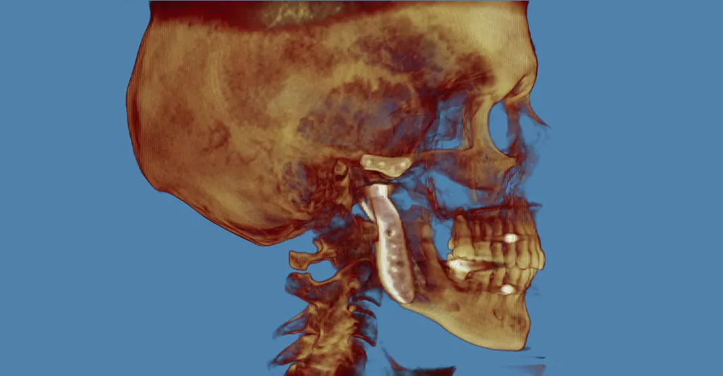 Grayscale 3D CT scan: lateral skull view with red marker on cranium