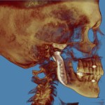 Grayscale 3D CT scan: lateral skull view with red marker on cranium