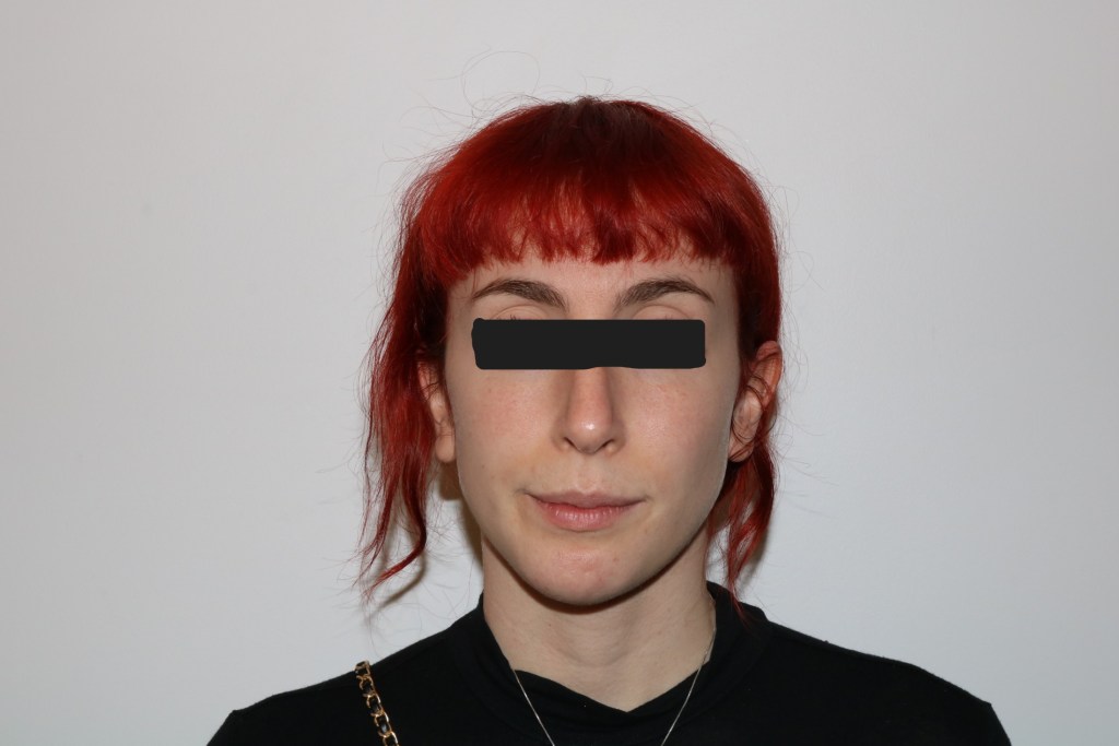 Frontal view focusing on chin symmetry with red vertical midline marker