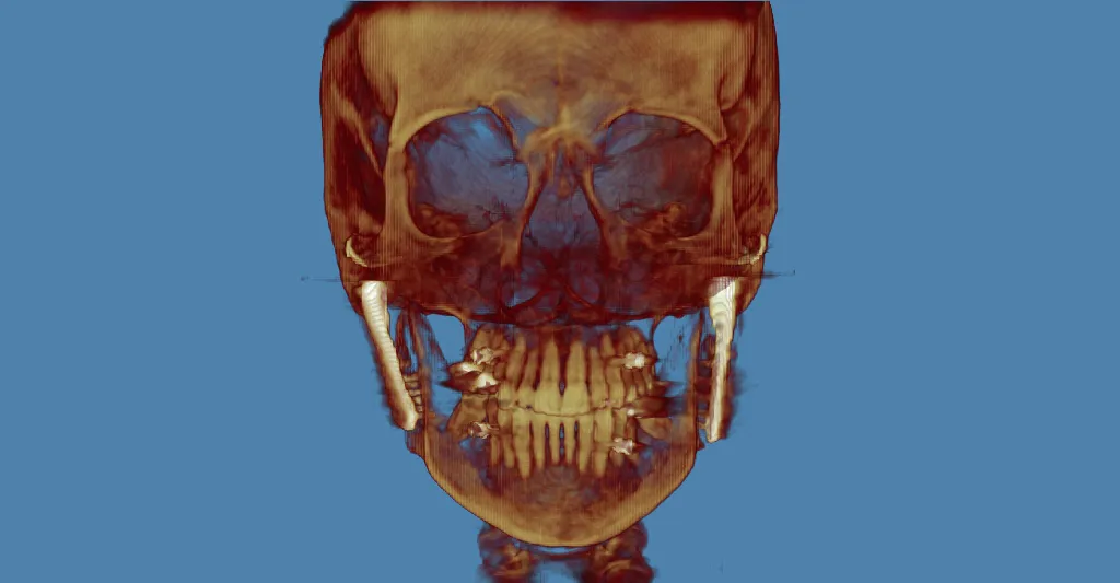 3D CT scan: frontal skull view with golden-brown rendering, blue background, teeth visible