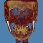 3D CT scan: frontal skull view with golden-brown rendering, blue background, teeth visible