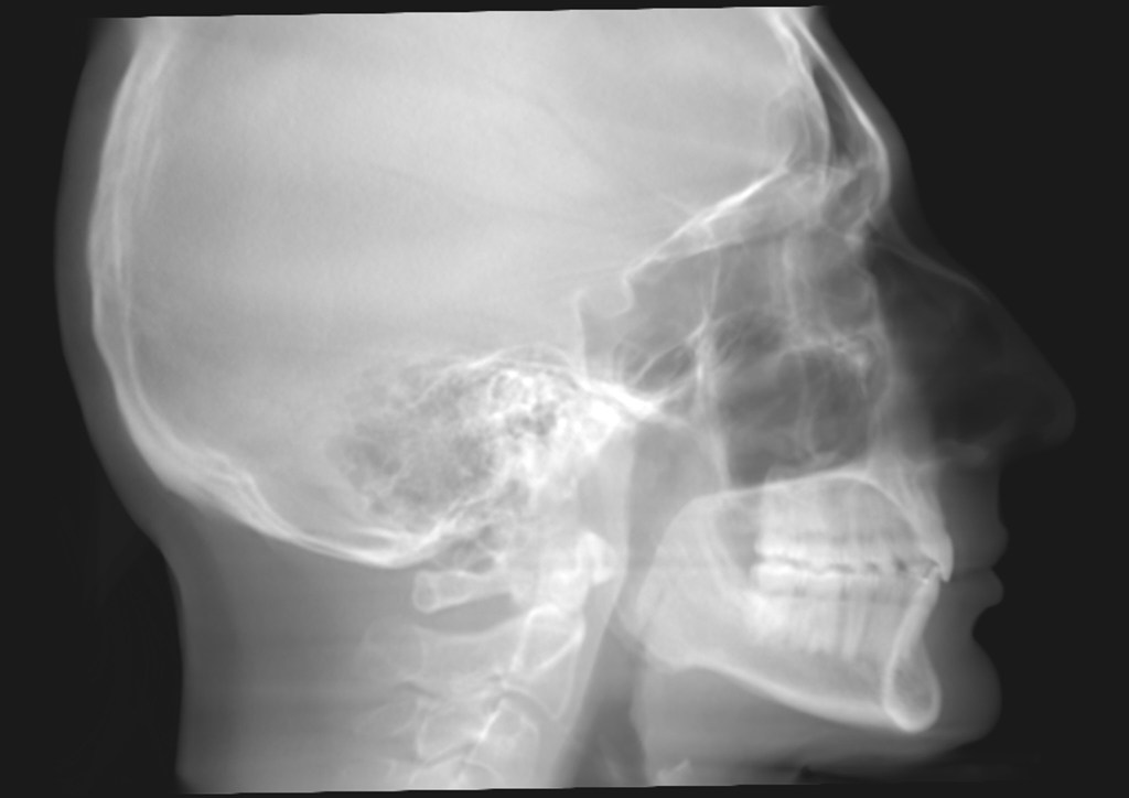 Grayscale lateral skull X-ray showing jaw, teeth, and cervical spine