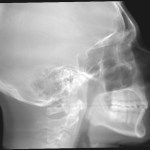 Grayscale lateral skull X-ray showing jaw, teeth, and cervical spine