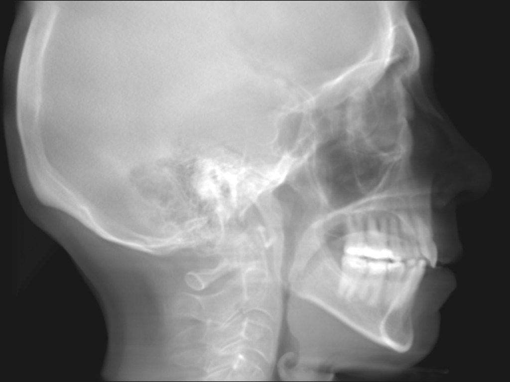 Grayscale lateral skull X-ray showing jaw, teeth, and cervical spine