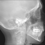Grayscale lateral skull X-ray showing jaw, teeth, and cervical spine