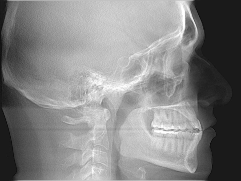 Grayscale lateral skull X-ray showing jaw, teeth, and cervical spine
