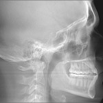 Grayscale lateral skull X-ray showing jaw, teeth, and cervical spine