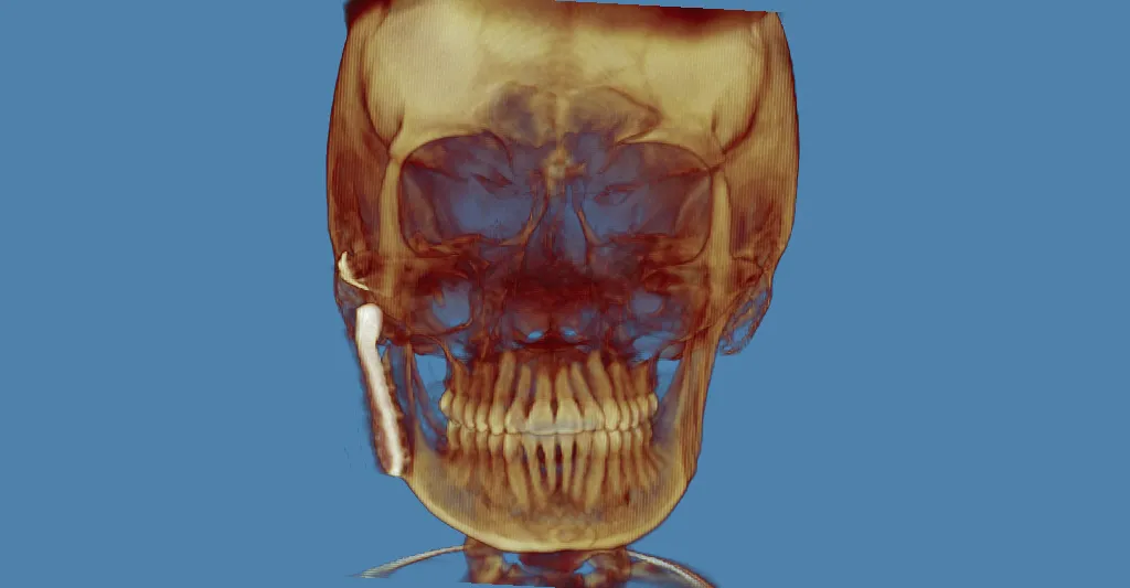 3D CT scan: lateral skull view with golden-brown rendering, blue background, dental structures visible